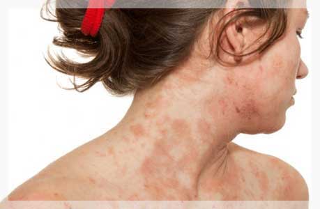 Atopik Dermatit (Alerjik Ekzama)