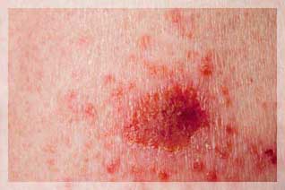 Bazal Hücreli Kanser