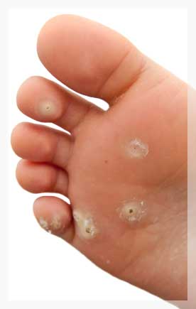 Human Papilloma Virüs Enfeksiyonu