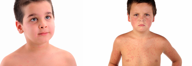 Kızamık, Kızamıkçık