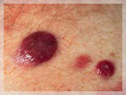 MIKOZIS FUNGOIDES TEDAVİSİ