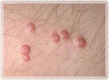 Molluskum Kontagiozum