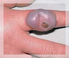 ORF (Ektima Kontagiozum)