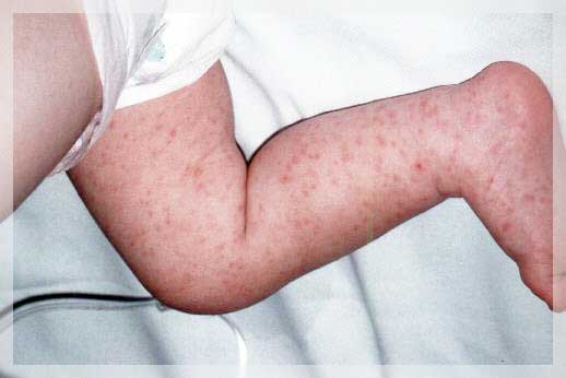 Pediyatrik Dermatoloji