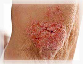 Sedef Hastalığı (Psoriasis)