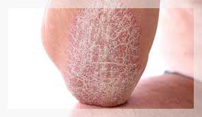 Sedef Hastalığı (Psoriasis)