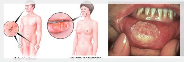 Skuamoz Hücreli Kanser