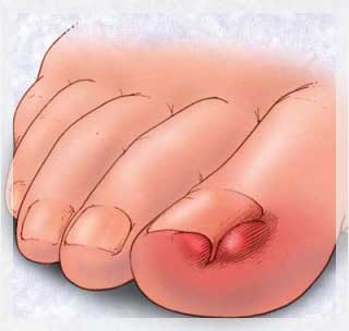 Tırnak Hastalıkları