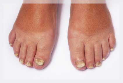 Tırnak Hastalıkları