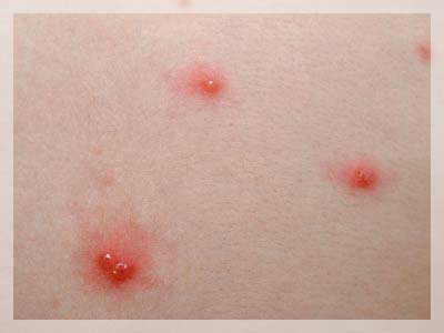 Varicella (Su Çiçeği)